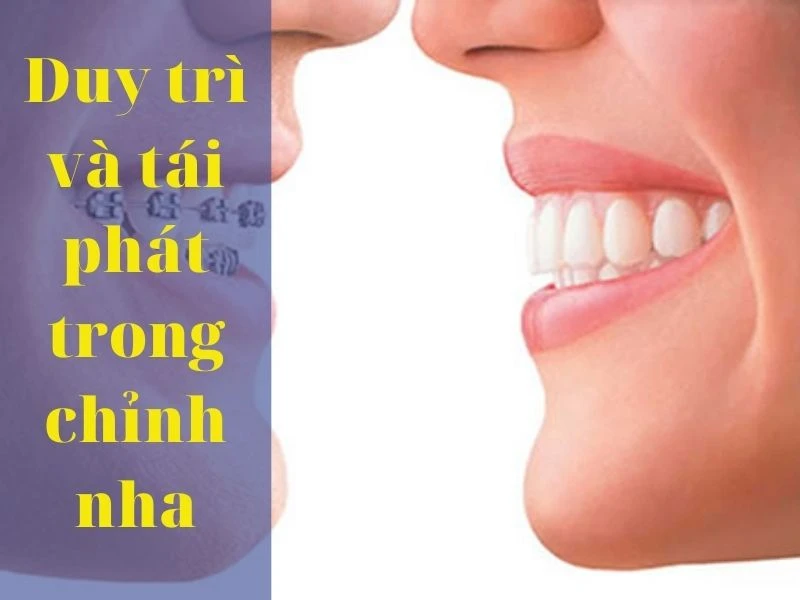 Duy trì và tái phát trong chỉnh nha (phần 1) – thực hành