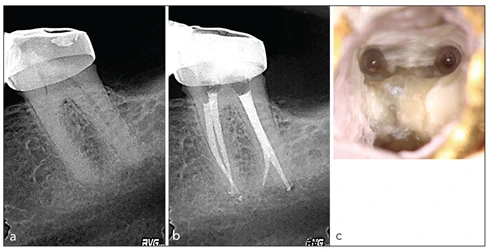 Điều trị nội nha – tạo hình và làm sạch ống tủy có giải phẫu phức tạp( phần 2)