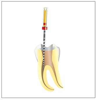 Điều trị nội nha – tạo hình và làm sạch ống tủy có giải phẫu phức tạp ( phần 1)