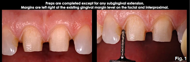 Xử lý đường hoàn tất dưới nướu ở những bệnh nhân có khe nướu cạn