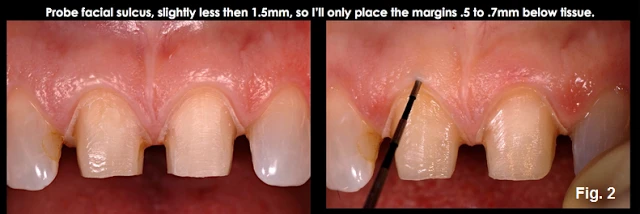 Xử lý đường hoàn tất dưới nướu ở những bệnh nhân có khe nướu cạn