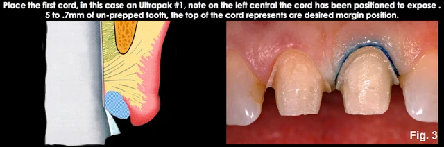 Xử lý đường hoàn tất dưới nướu ở những bệnh nhân có khe nướu cạn