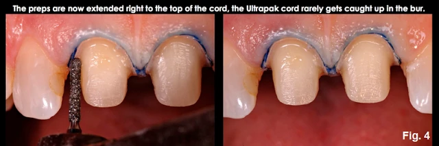 Xử lý đường hoàn tất dưới nướu ở những bệnh nhân có khe nướu cạn