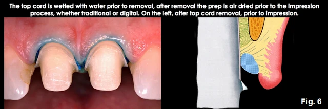 Xử lý đường hoàn tất dưới nướu ở những bệnh nhân có khe nướu cạn