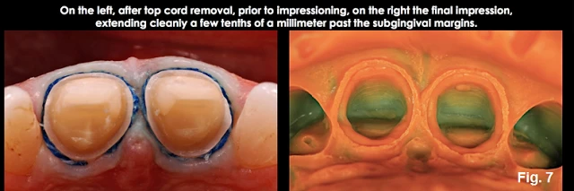Xử lý đường hoàn tất dưới nướu ở những bệnh nhân có khe nướu cạn