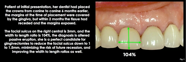 Xử lý đường hoàn tất dưới nướu ở bệnh nhân có khe nướu sâu