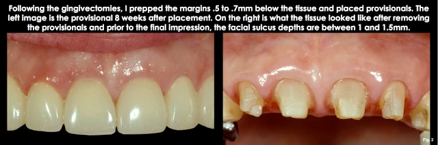 Xử lý đường hoàn tất dưới nướu ở bệnh nhân có khe nướu sâu