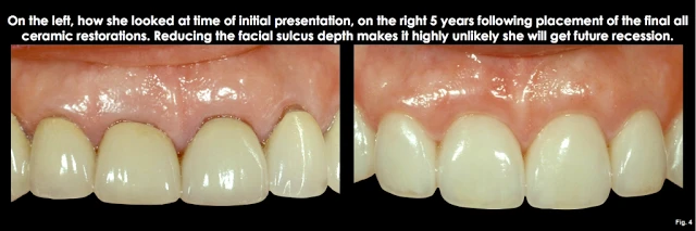 Xử lý đường hoàn tất dưới nướu ở bệnh nhân có khe nướu sâu