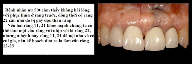 Xử lý đường hoàn tất dưới nướu ở bệnh nhân có khe nướu sâu