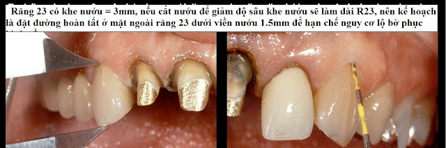 Xử lý đường hoàn tất dưới nướu ở bệnh nhân có khe nướu sâu