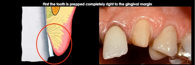 Xử lý đường hoàn tất dưới nướu ở bệnh nhân có khe nướu sâu