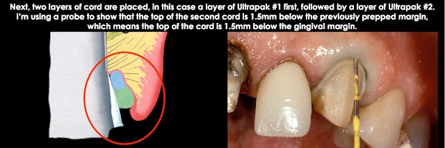 Xử lý đường hoàn tất dưới nướu ở bệnh nhân có khe nướu sâu