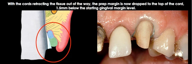 Xử lý đường hoàn tất dưới nướu ở bệnh nhân có khe nướu sâu