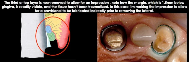 Xử lý đường hoàn tất dưới nướu ở bệnh nhân có khe nướu sâu