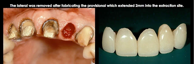 Xử lý đường hoàn tất dưới nướu ở bệnh nhân có khe nướu sâu