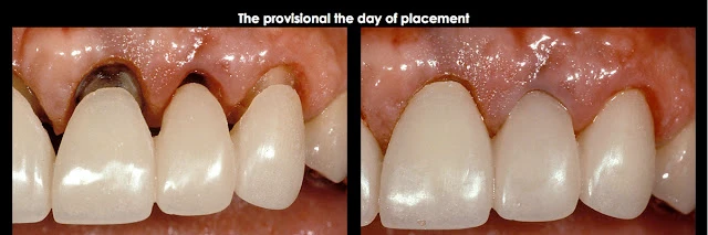 Xử lý đường hoàn tất dưới nướu ở bệnh nhân có khe nướu sâu
