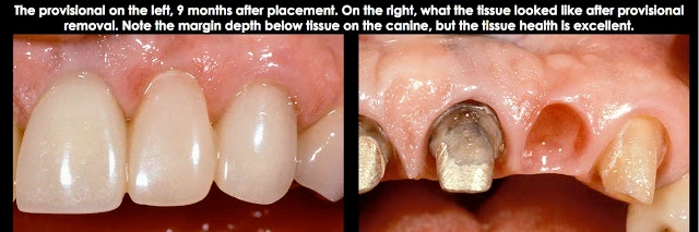 Xử lý đường hoàn tất dưới nướu ở bệnh nhân có khe nướu sâu