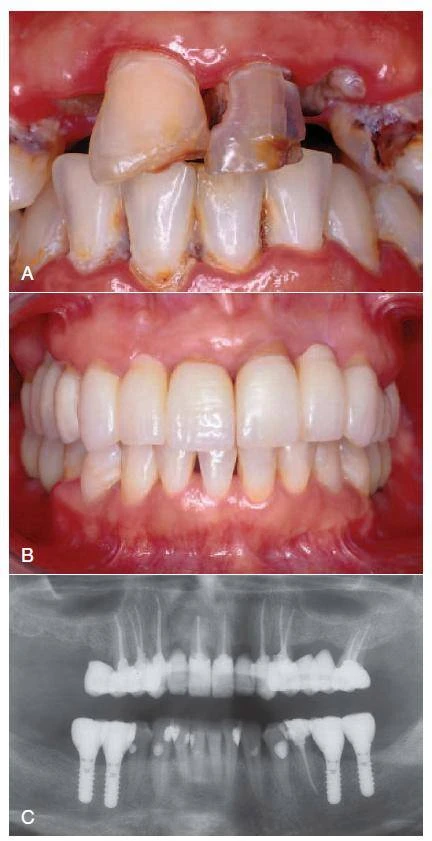 Điều trị tủy – làm sạch và tạo hình ống tủy (phần 1)