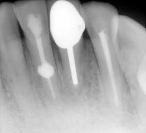 Phân biệt sự khác nhau giữa tổn thương nội tiêu và ngoại tiêu trên phim X-quang