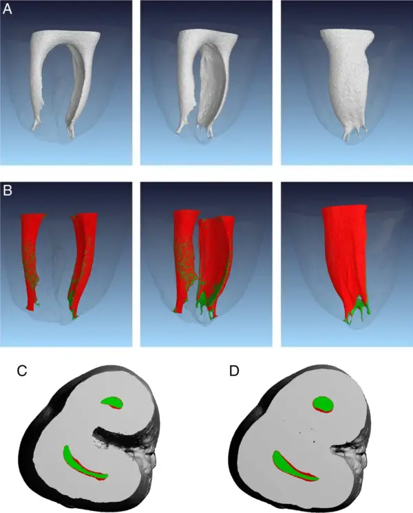 Sự thật đằng sau ống tủy “hoàn hảo” trên X-quang: tại sao trâm quay NiTi không thể làm sạch 100%?