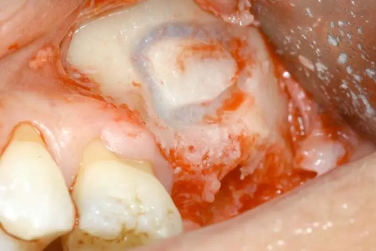 Piezosurgery: nguyên lý cắt chọn lọc giúp nâng xoang không rách màng